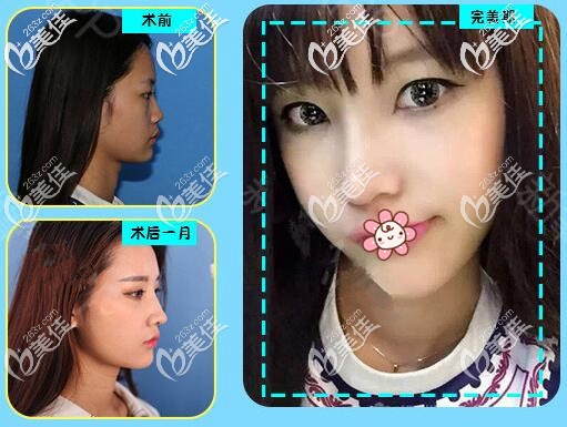 罗志敏肋软骨隆鼻案例