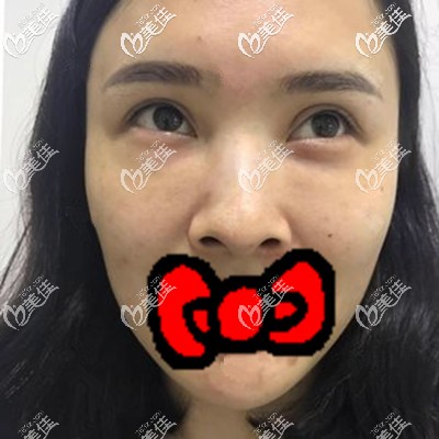 自体脂肪填充泪沟术前照 自体脂肪填充泪沟术前照