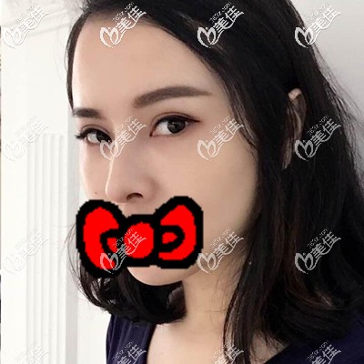 填泪沟术后1个月照片 填泪沟术后1个月照片