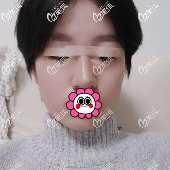 体验贝塞尔双眼皮术后2天照