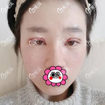 做贝塞尔双眼皮术后3天照片