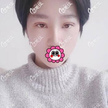 做双眼皮术后5天时的恢复效果照