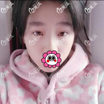 在大连做双眼皮术后25天恢复照