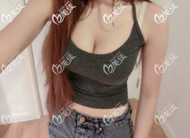 西安高一生自体脂肪隆胸术后两个月的样子
