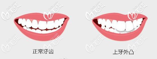 门牙外凸建议做矫正来改善