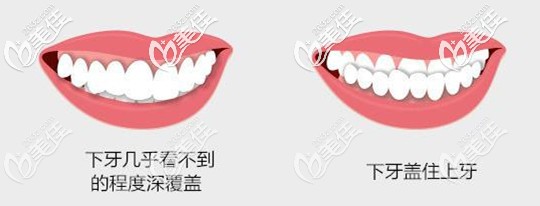 正常的咬合关系和咬合不正常的图片