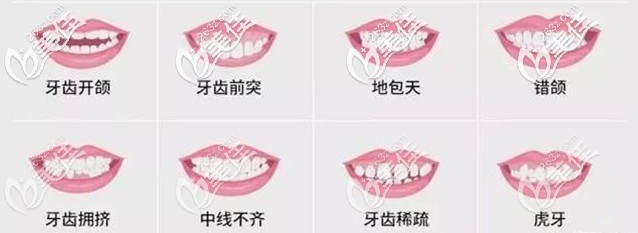 牙齿出现这些情况就要考虑矫正啦