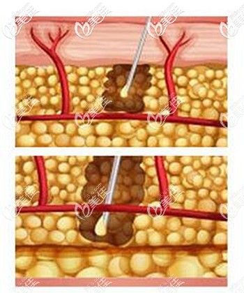 泉州欧菲自体脂肪丰胸的优势 泉州欧菲自体脂肪丰胸的优势