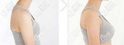 泉州欧菲自体脂肪丰胸案例 泉州欧菲自体脂肪丰胸案例