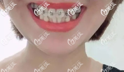 我刚戴牙套时牙齿的样子 我刚戴牙套时牙齿的样子