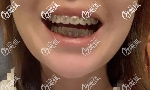 在重庆渝北牙科医院拔了4颗4号牙,戴damon自锁牙套矫正两年花费三万,结果....