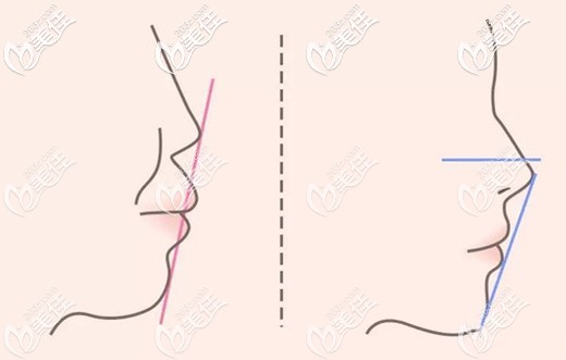 在重庆矫正牙齿后的侧貌变化效果图 在重庆矫正牙齿后的侧貌变化效果图