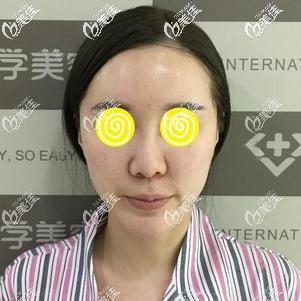 做鼻综合手术前难看的鼻形 做鼻综合手术前难看的鼻形