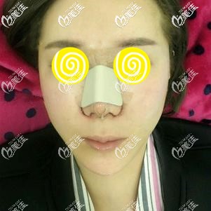 找阪田和明医生做鼻综合术后效果明显 找阪田和明医生做鼻综合术后效果明显