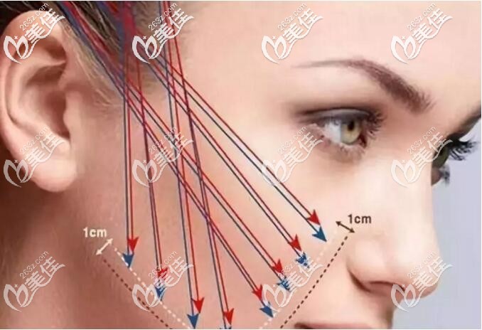 埋线的层次决定位置 埋线的层次决定位置