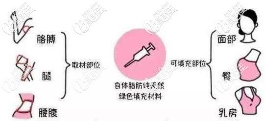 自体脂肪移植填充 自体脂肪移植填充