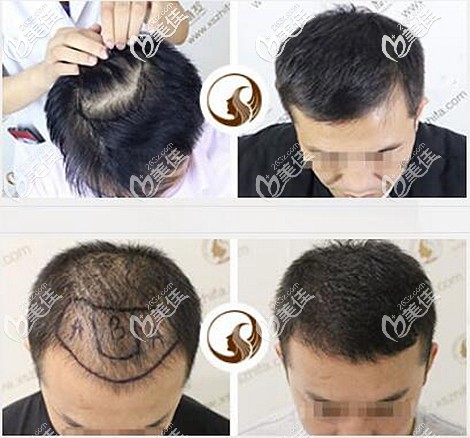 头顶加密种植案例效果图