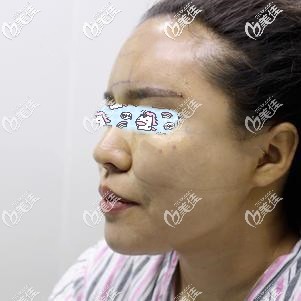 硅胶垫下巴术后12天效果