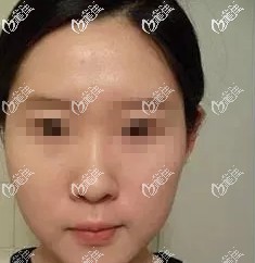 术前鼻子塌平 术前鼻子塌平