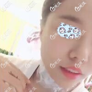 假体垫下巴术后30天婆婆嘴变轻