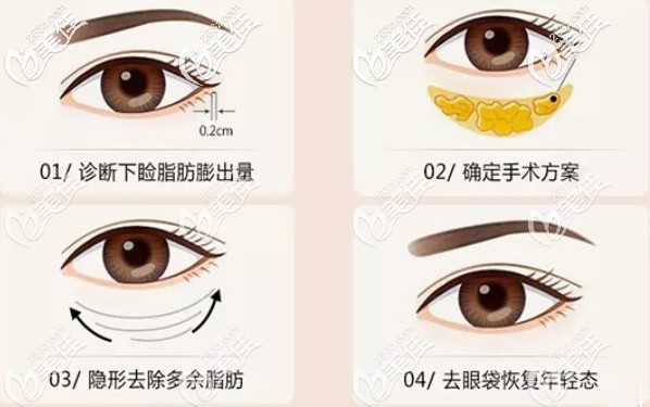 聚能美雕祛眼袋过程 聚能美雕祛眼袋过程