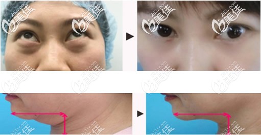 聚能美雕去除眼袋和双下巴效果 聚能美雕去除眼袋和双下巴效果