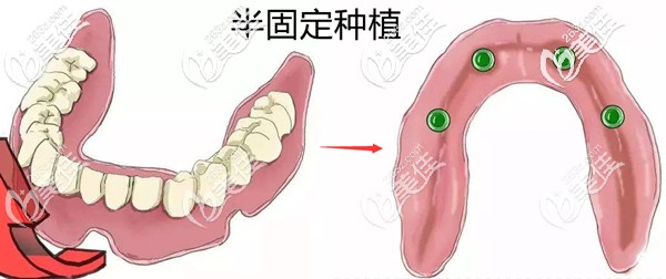 半固定种植牙的原理示意图