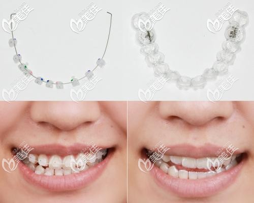 托槽矫正和隐形矫正对比 托槽矫正和隐形矫正对比