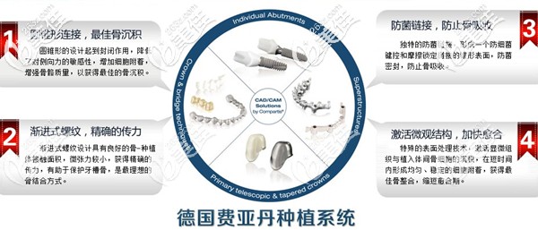 德国费亚丹ankyos Xive种植体