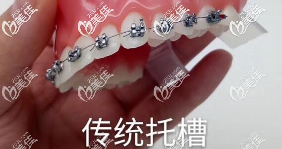 传统金属托槽矫正器