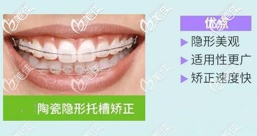 半隐形陶瓷托槽矫正器