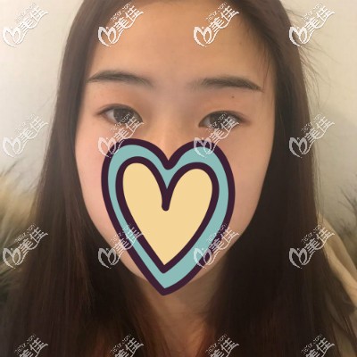做眼综合术前照片 做眼综合术前照片