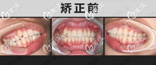 突嘴龅牙在北京牙管家口腔矫正前照片 突嘴龅牙在北京牙管家口腔矫正前照片
