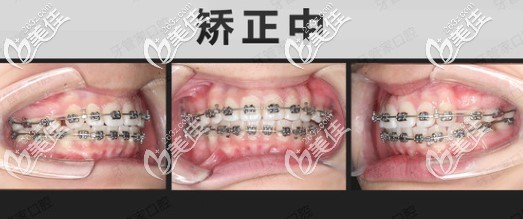 骨性龅牙做金属自锁托槽矫正中 骨性龅牙做金属自锁托槽矫正中