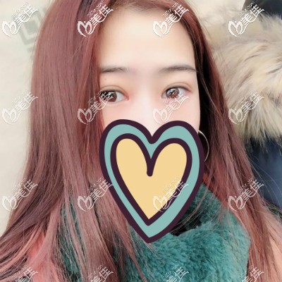 眼综合术后三个月恢复得越来越自然好看 眼综合术后三个月恢复得越来越自然好看