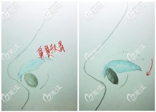 鼻翼缘退缩多数都要把鼻翼软骨下拉改善 鼻翼缘退缩多数都要把鼻翼软骨下拉改善