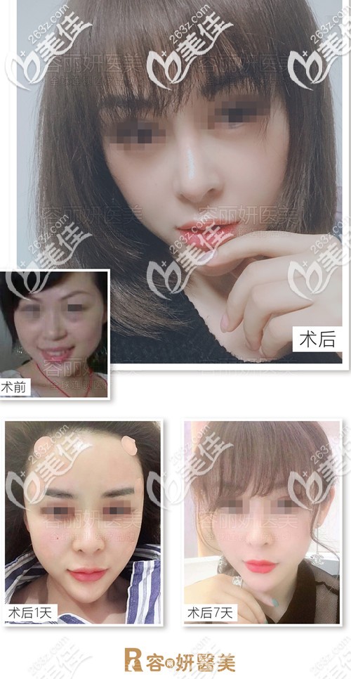 32岁在张家港容丽妍同时做了10mm双眼皮+脂肪填充