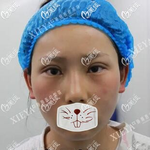 双眼皮开眼角术后即刻效果照