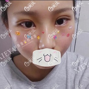 在长沙割双眼皮开眼角术后3天效果图