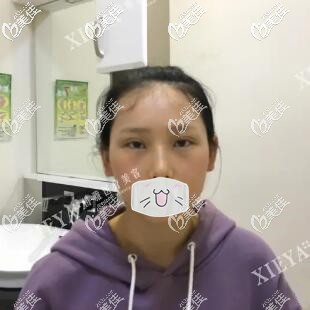 割双眼皮开眼角7天拆线