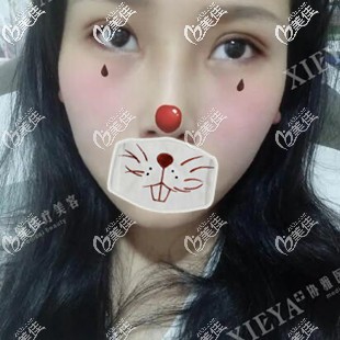 双眼皮开内眼角术后24天恢复效果照