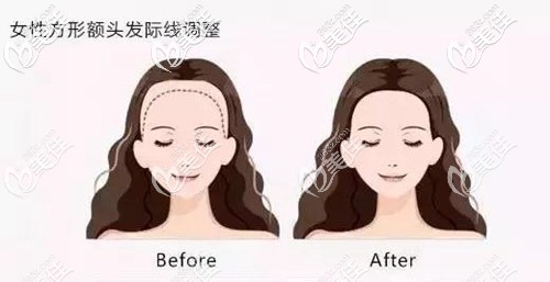 女性方形额头发际线调整 女性方形额头发际线调整