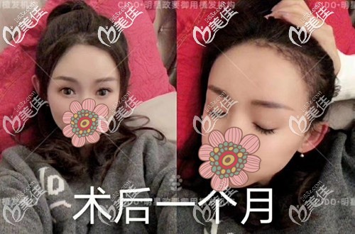 前额发际线种植一个月效果图 前额发际线种植一个月效果图
