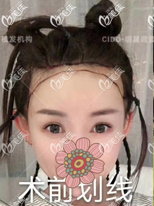 术前设计发际线种植线条 术前设计发际线种植线条