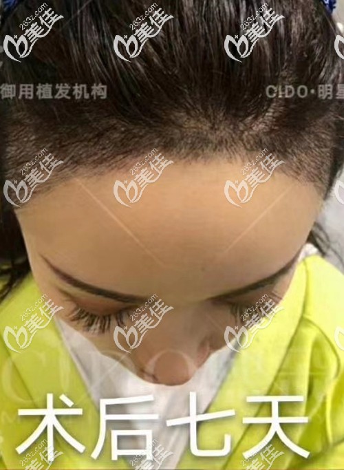 看到我用AHT技术植发际线一个月的效果图，我感觉我不做发际线种植才会后悔终身吧!