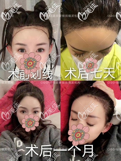 发际线种植手术恢复过程 发际线种植手术恢复过程