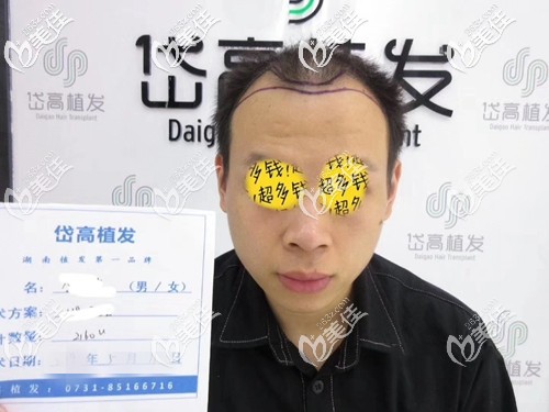 术前发际线脱发、头发稀疏