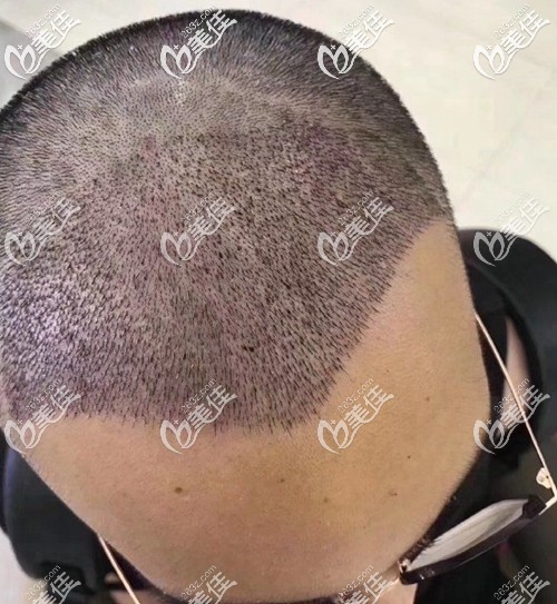做了前额发际线种植术后第4天