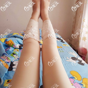 吸脂瘦大腿术后7天腿部依旧肿胀