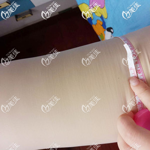 大腿吸脂术后25天腿围有了变化